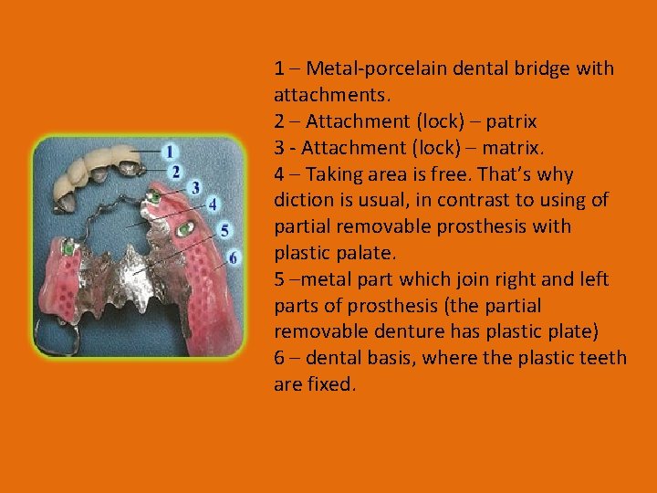 1 – Metal-porcelain dental bridge with attachments. 2 – Attachment (lock) – patrix 3