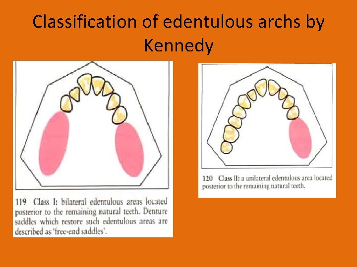 Classification of edentulous archs by Kennedy 