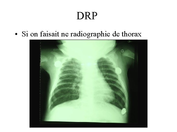 DRP • Si on faisait ne radiographie de thorax 