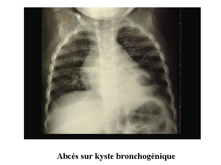 Abcès sur kyste bronchogénique 
