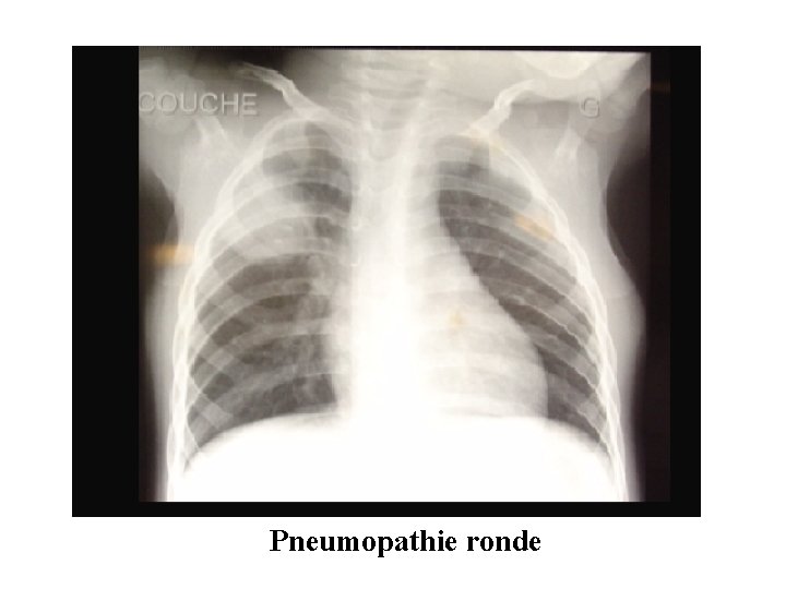 Pneumopathie ronde 