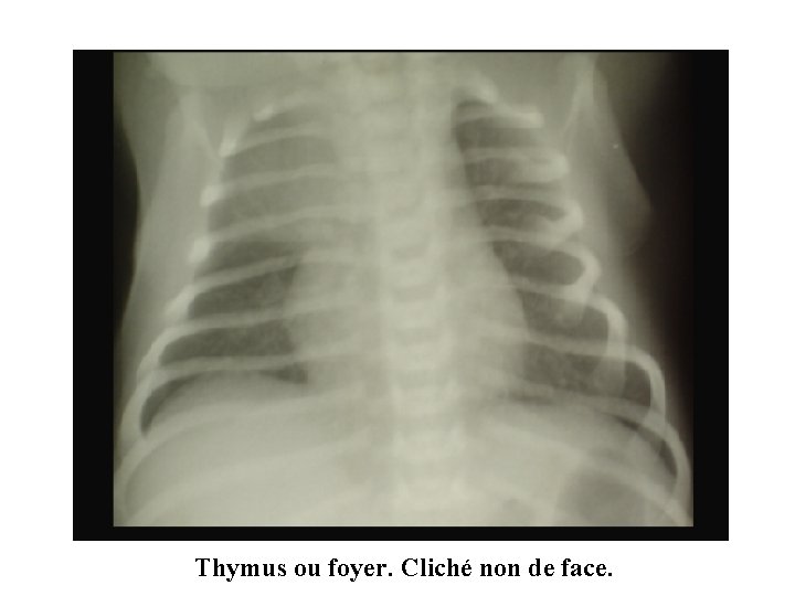 Thymus ou foyer. Cliché non de face. 