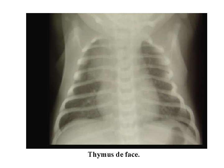 Thymus de face. 