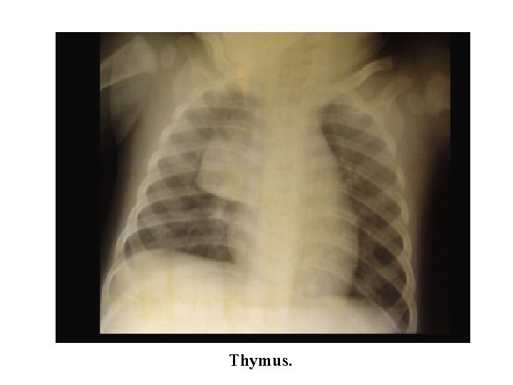 Thymus. 