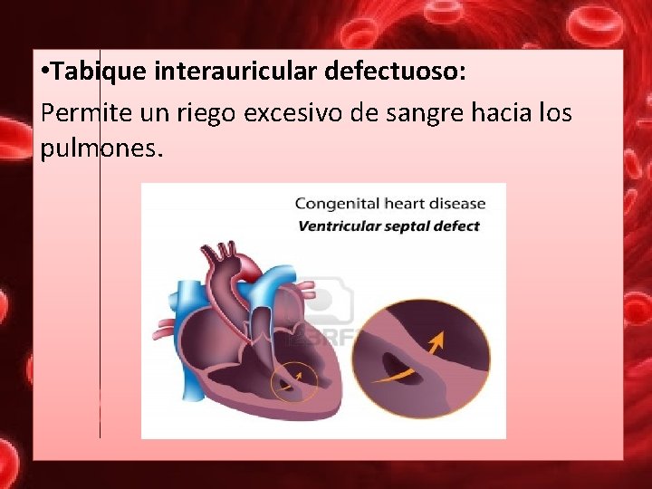  • Tabique interauricular defectuoso: Permite un riego excesivo de sangre hacia los pulmones.