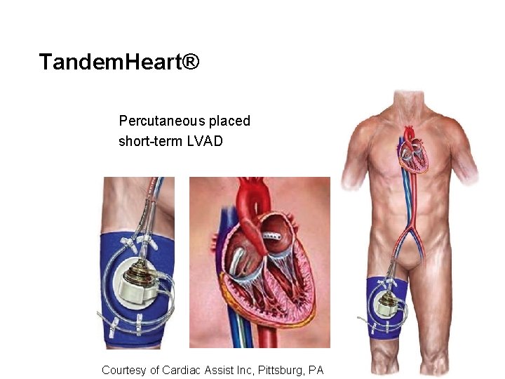 Tandem. Heart® Percutaneous placed short-term LVAD Courtesy of Cardiac Assist Inc, Pittsburg, PA 