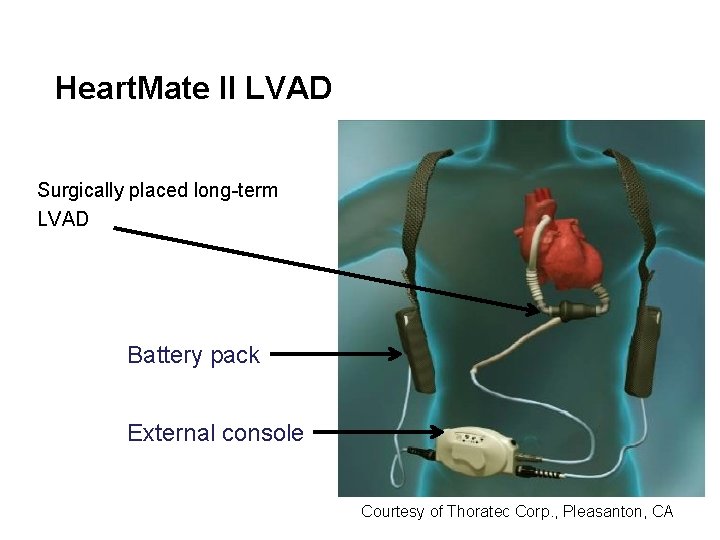 Heart. Mate II LVAD Surgically placed long-term LVAD Battery pack External console Courtesy of