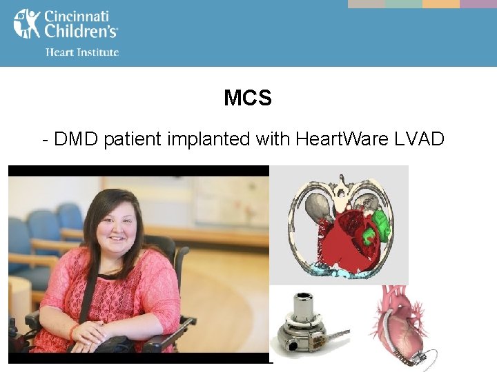 MCS - DMD patient implanted with Heart. Ware LVAD 