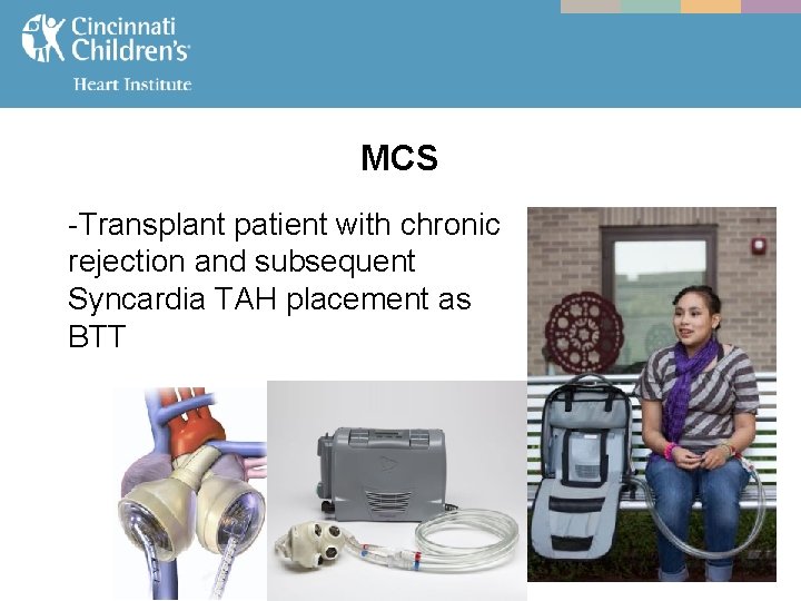 MCS -Transplant patient with chronic rejection and subsequent Syncardia TAH placement as BTT 