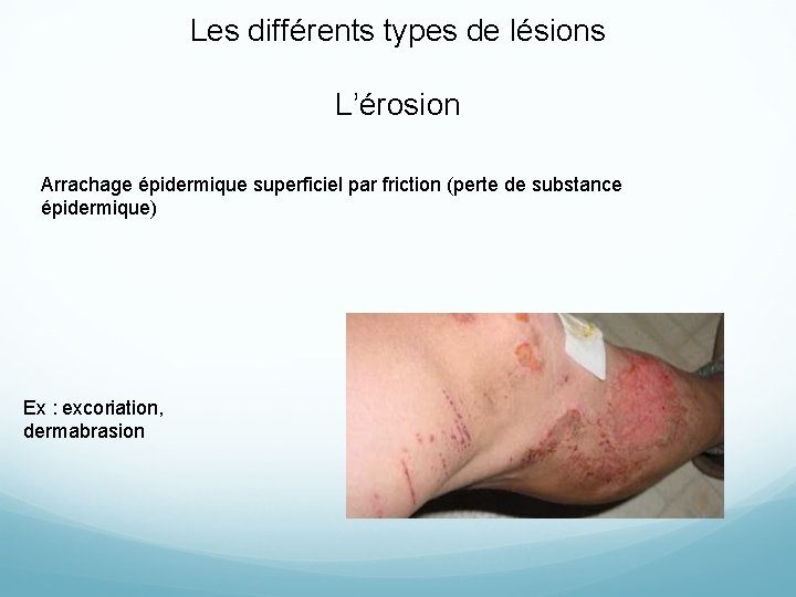 Les différents types de lésions L’érosion Arrachage épidermique superficiel par friction (perte de substance