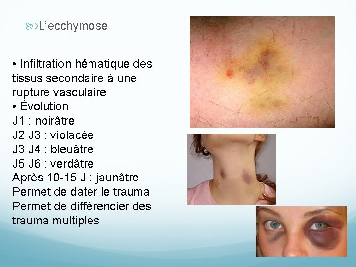  L’ecchymose • Infiltration hématique des tissus secondaire à une rupture vasculaire • Évolution