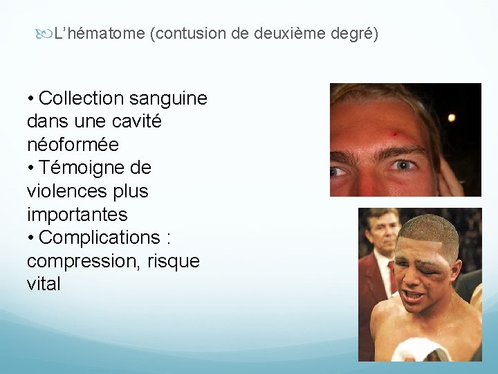  L’hématome (contusion de deuxième degré) • Collection sanguine dans une cavité néoformée •