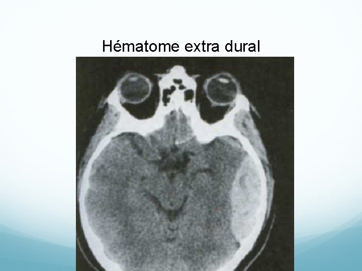 Hématome extra dural 