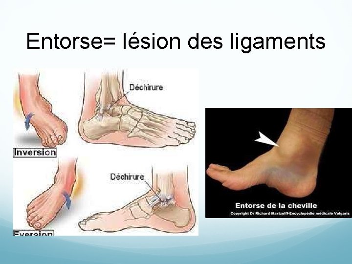 Entorse= lésion des ligaments 