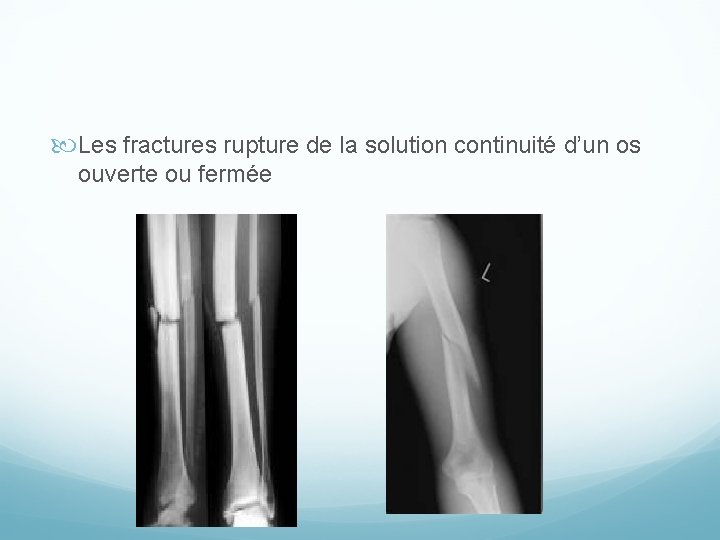  Les fractures rupture de la solution continuité d’un os ouverte ou fermée 