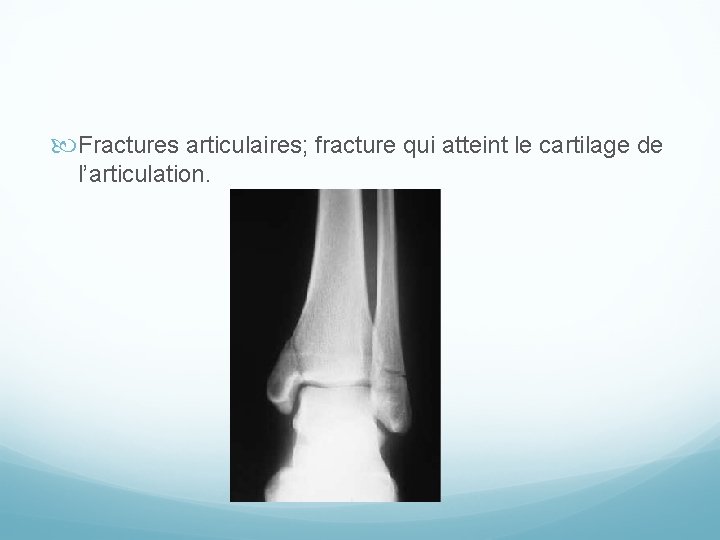  Fractures articulaires; fracture qui atteint le cartilage de l’articulation. 