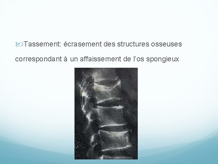  Tassement: écrasement des structures osseuses correspondant à un affaissement de l’os spongieux 