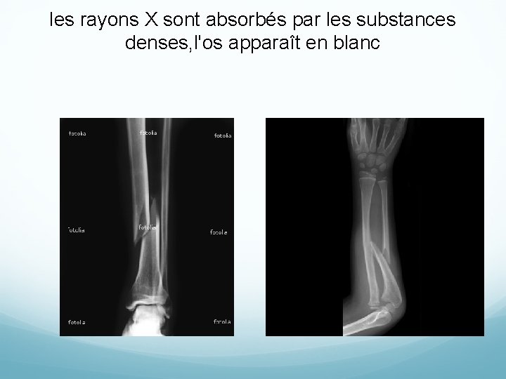les rayons X sont absorbés par les substances denses, l'os apparaît en blanc 
