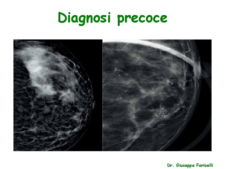 Diagnosi precoce Dr. Giuseppe Fariselli 