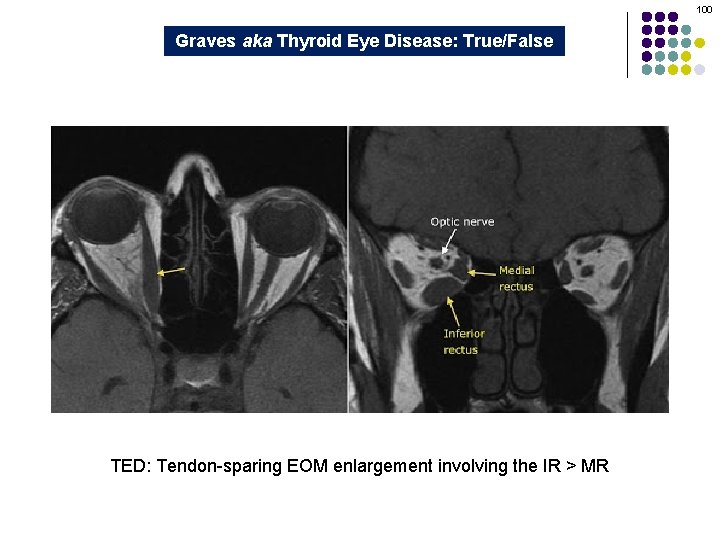 100 Graves aka Thyroid Eye Disease: True/False TED: Tendon-sparing EOM enlargement involving the IR