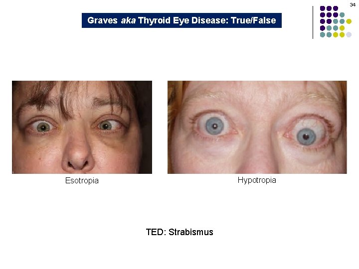 34 Graves aka Thyroid Eye Disease: True/False Hypotropia Esotropia TED: Strabismus 