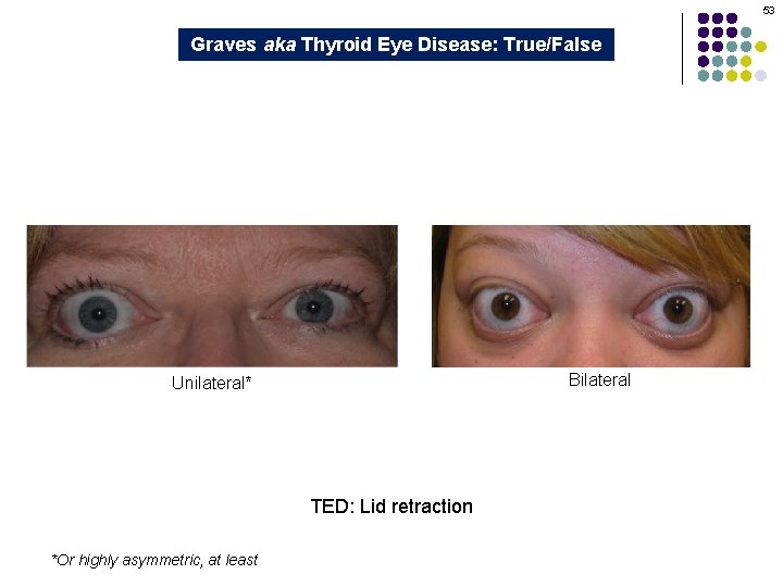 53 Graves aka Thyroid Eye Disease: True/False Bilateral Unilateral* TED: Lid retraction *Or highly