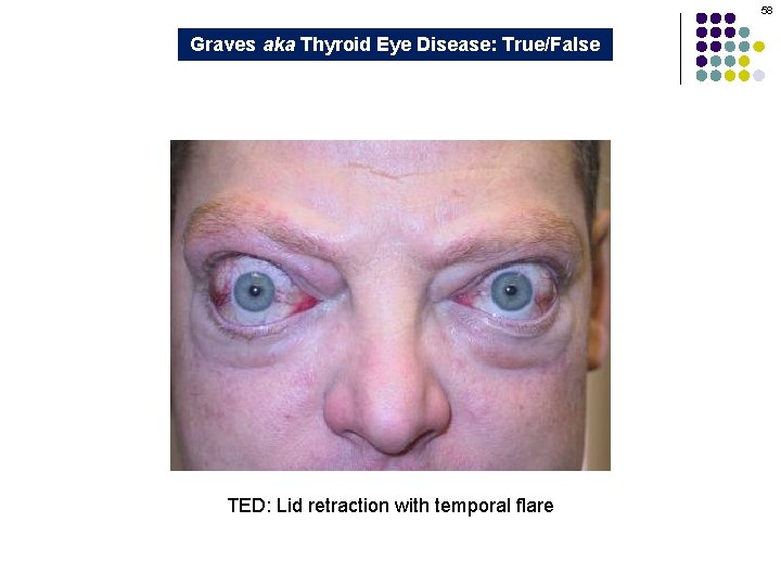 58 Graves aka Thyroid Eye Disease: True/False TED: Lid retraction with temporal flare 