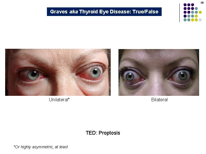 66 Graves aka Thyroid Eye Disease: True/False Unilateral* Bilateral TED: Proptosis *Or highly asymmetric,