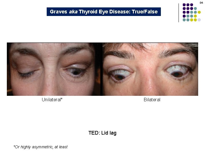 84 Graves aka Thyroid Eye Disease: True/False Unilateral* Bilateral TED: Lid lag *Or highly