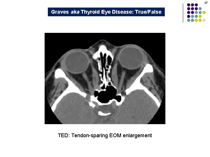 97 Graves aka Thyroid Eye Disease: True/False TED: Tendon-sparing EOM enlargement 