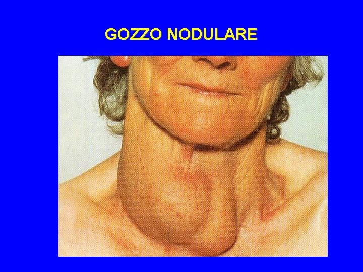 GOZZO NODULARE 