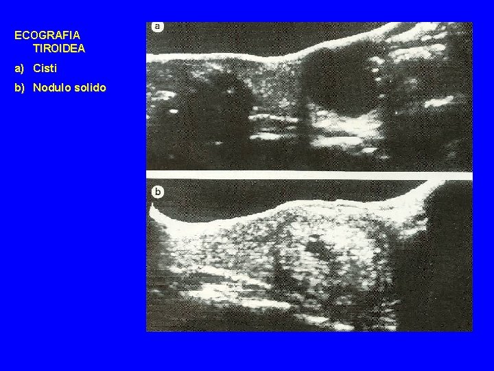 ECOGRAFIA TIROIDEA a) Cisti b) Nodulo solido 