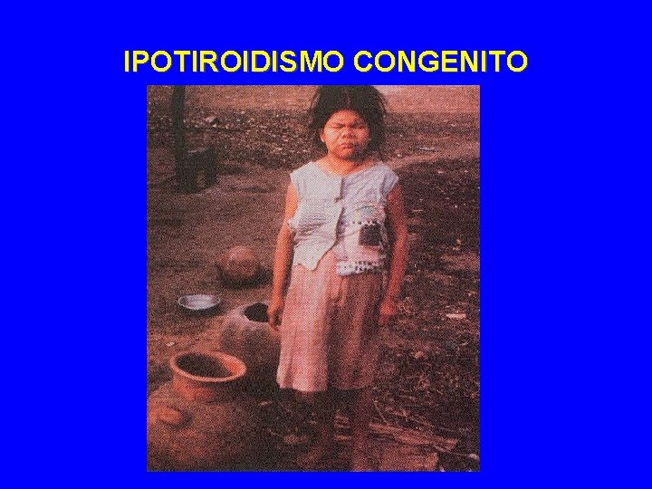 IPOTIROIDISMO CONGENITO 