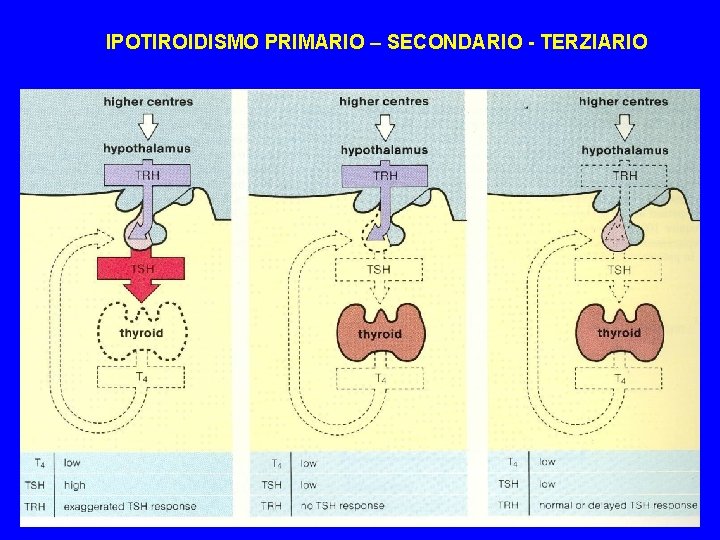 IPOTIROIDISMO PRIMARIO – SECONDARIO - TERZIARIO 