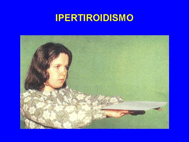 IPERTIROIDISMO 