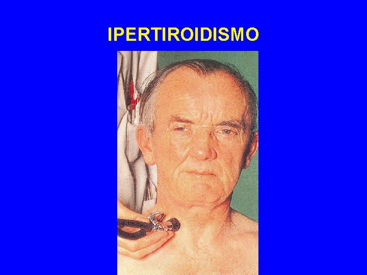 IPERTIROIDISMO 