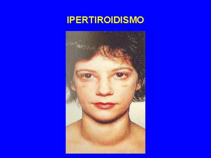 IPERTIROIDISMO 