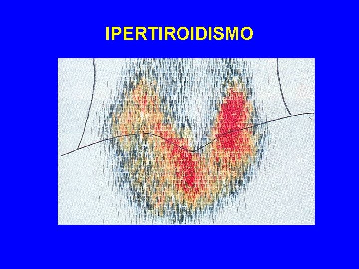 IPERTIROIDISMO 