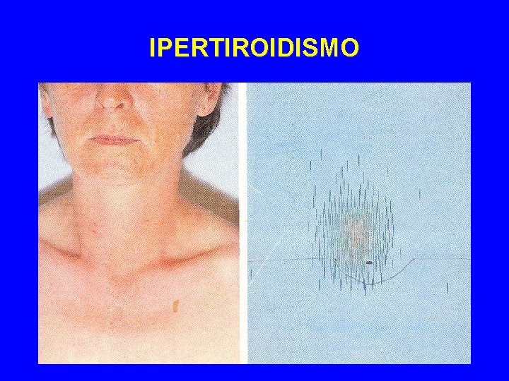 IPERTIROIDISMO 