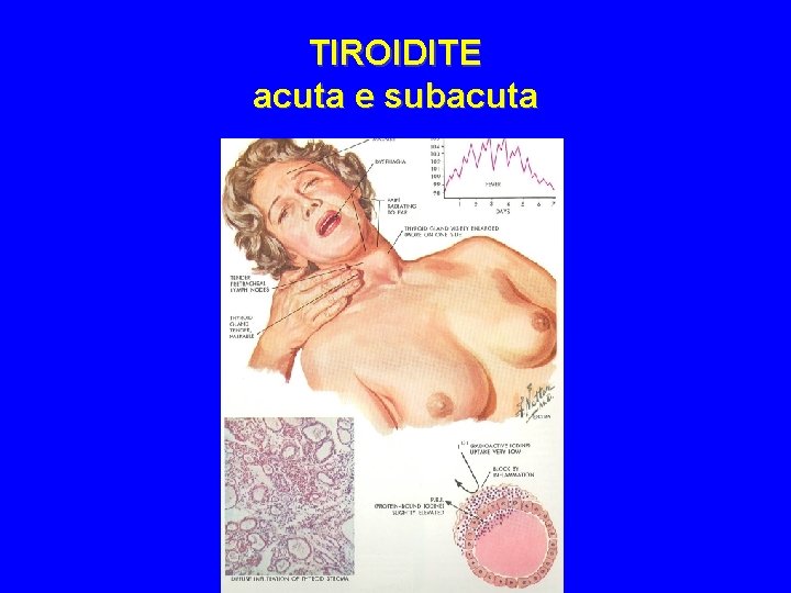 TIROIDITE acuta e subacuta 