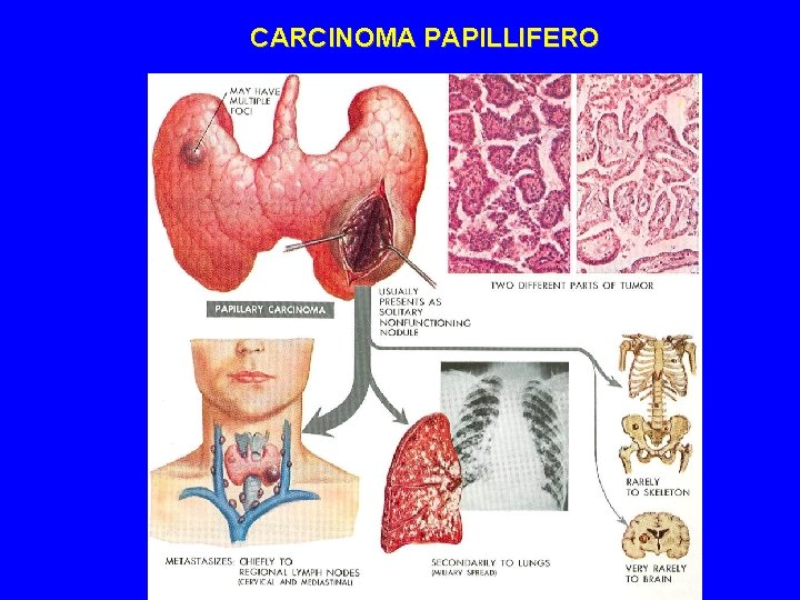 CARCINOMA PAPILLIFERO 