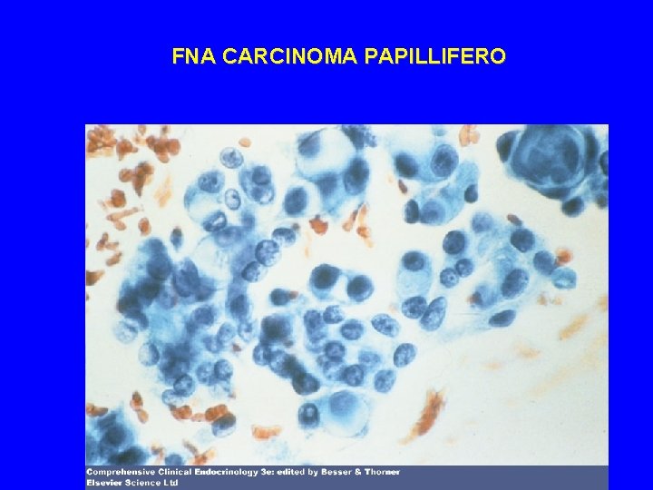 FNA CARCINOMA PAPILLIFERO 