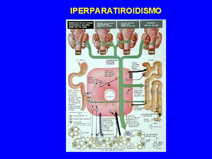 IPERPARATIROIDISMO 