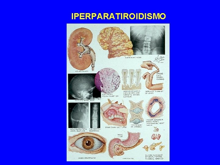 IPERPARATIROIDISMO 