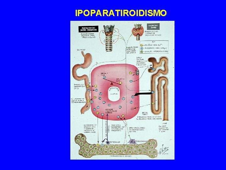 IPOPARATIROIDISMO 