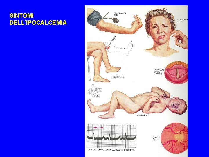 SINTOMI DELL’IPOCALCEMIA 