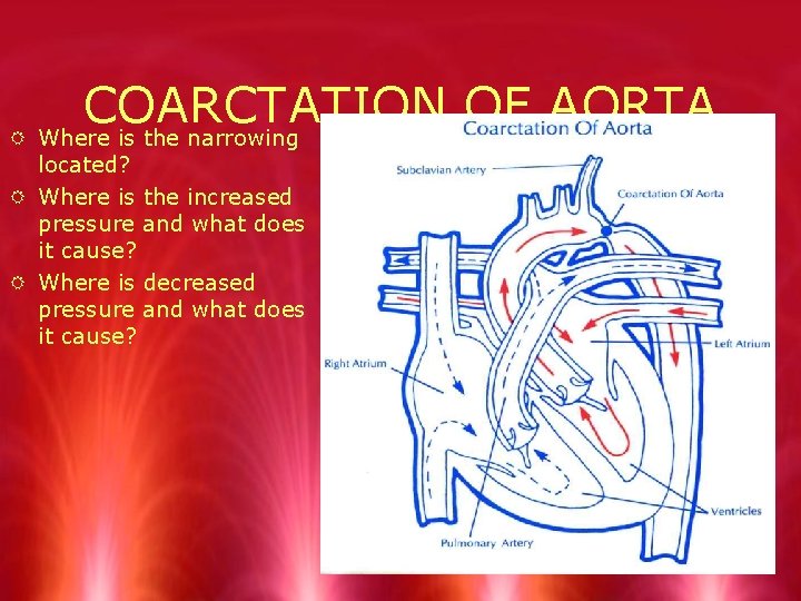 COARCTATION OF AORTA R Where is the narrowing located? R Where is the increased