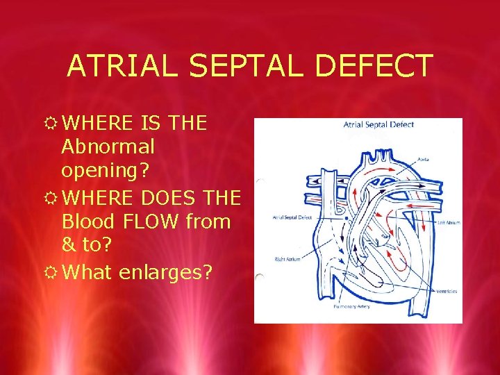 ATRIAL SEPTAL DEFECT R WHERE IS THE Abnormal opening? R WHERE DOES THE Blood