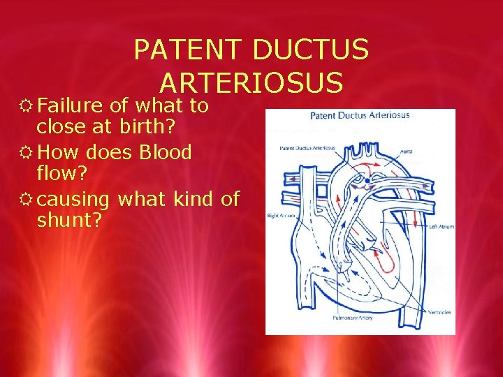 PATENT DUCTUS ARTERIOSUS R Failure of what to close at birth? R How does