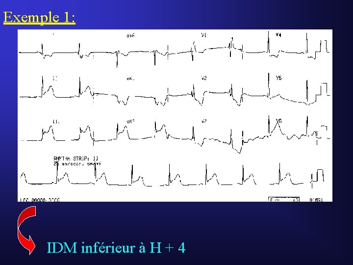 Exemple 1: IDM inférieur à H + 4 Exemple 1: IDM inférieur à H + 4